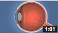 How The Eye Sees Glaucoma - Español